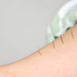 Dry Needling