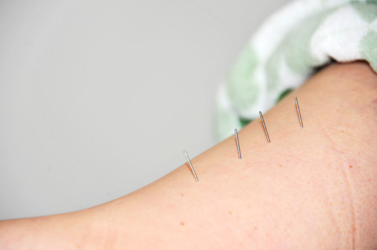 Dry Needling