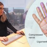 Carpal Tunnel Syndrome