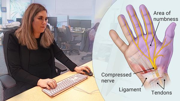 Carpal Tunnel Syndrome