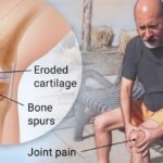 Osteoarthritis