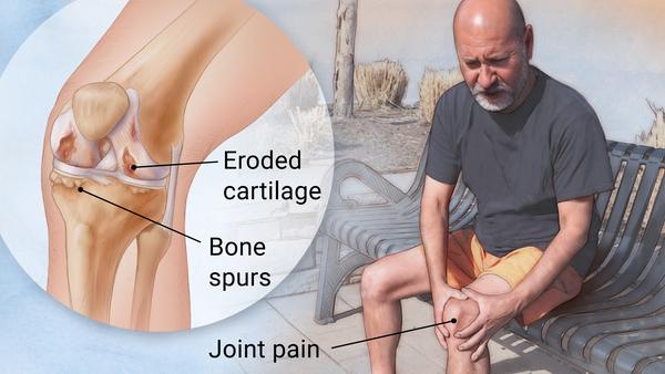 Osteoarthritis