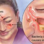 Sinus Pains & Headaches