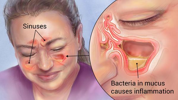 Sinus Pains & Headaches