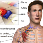 Thoracic Outlet Syndrome