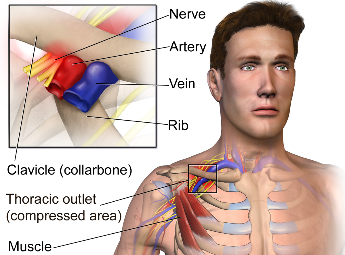 Thoracic Outlet Syndrome